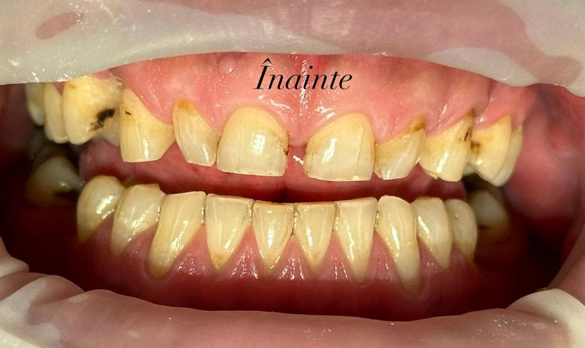 Caz 1 — Înainte